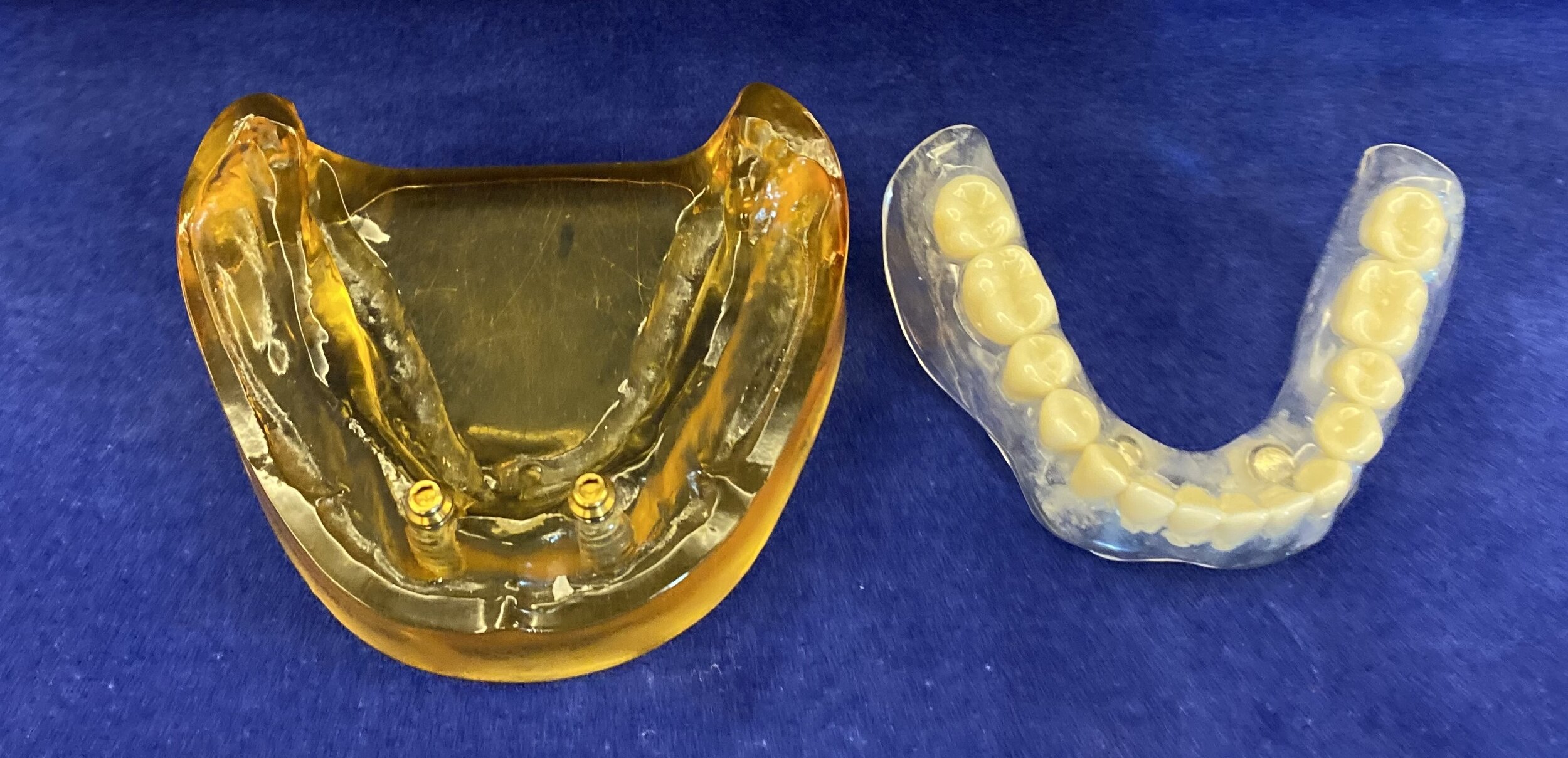 View of abutments in the mouth and top of denture