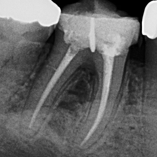 endo.jpg
