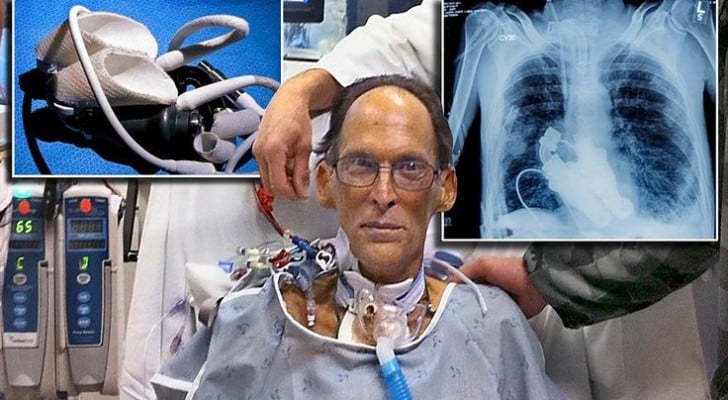 A post op Lewis