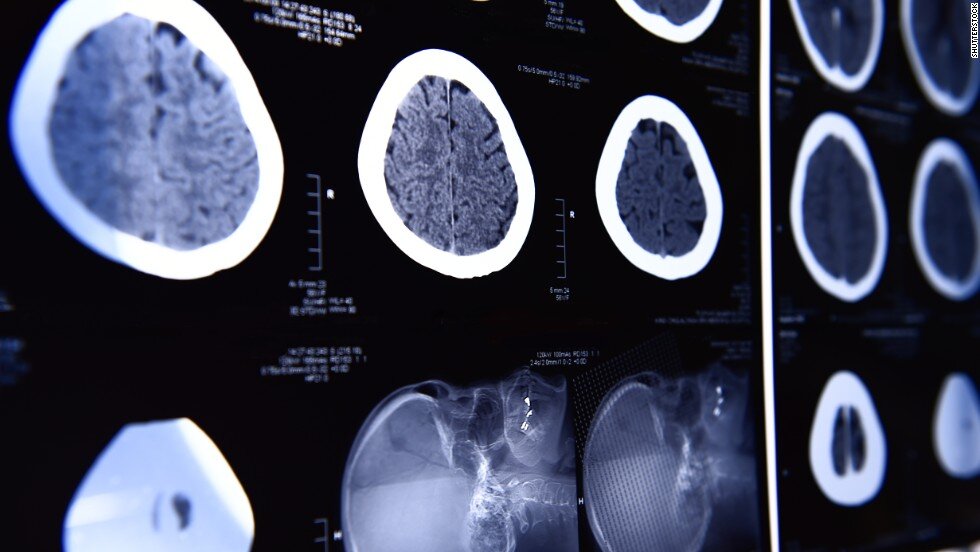 CNN: Brain scans could help doctors better predict your behavior