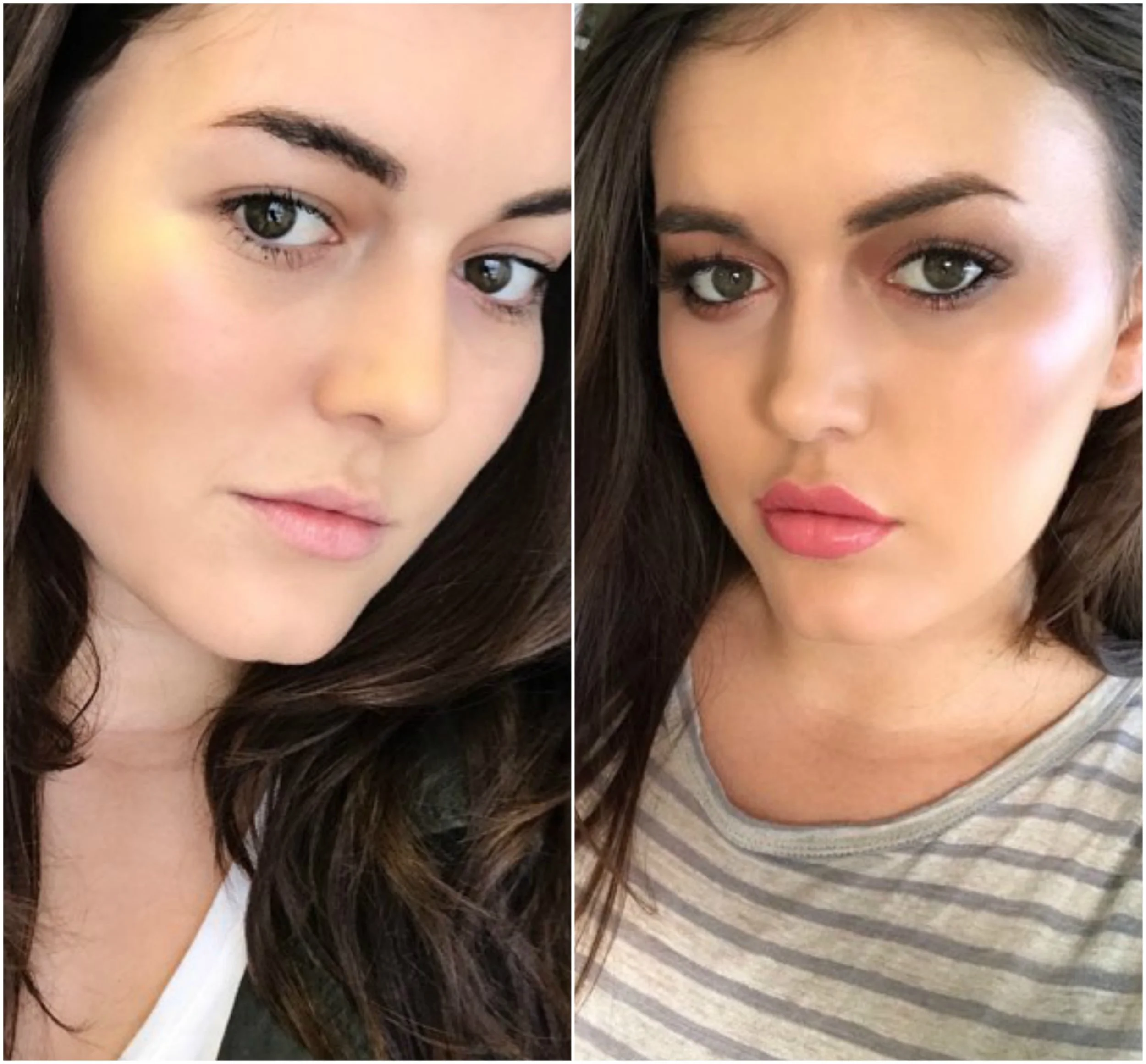 What It S Really Like To Get Lip Injections For The First Time Naked Vogue