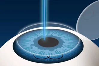 lasik-enhancement-330x220.jpg