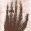 The world's first x-ray: Roentgen's wife, Bertha's hand