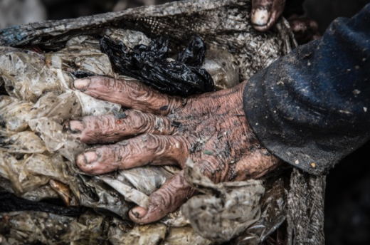 Working day in, day out at the landfill, handling the rotting, decomposing rubbish with little to no protection takes a serious toll on the basic health of all the inhabitants here.