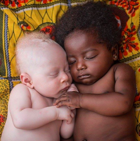On the left, a baby with albinism. Kaysha. CC BY-NC-ND 2.0