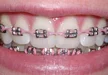 Traditional Braces