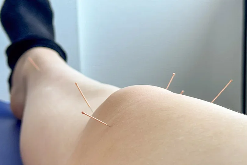Winter pain and circulation support with acupuncture in Lewes
