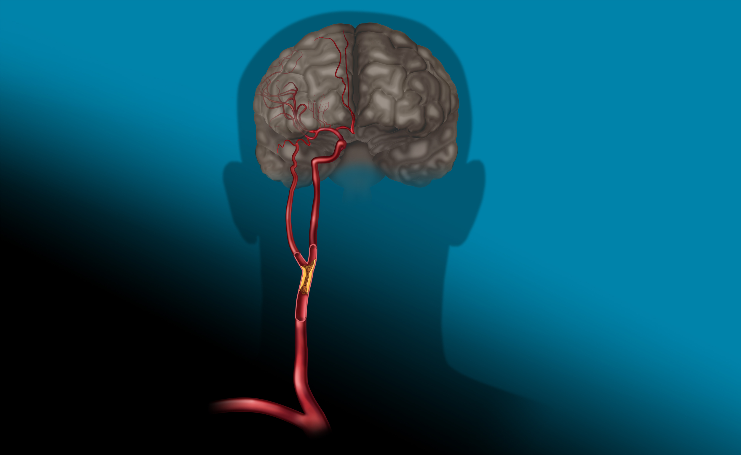 Plaque carotid circ.jpg