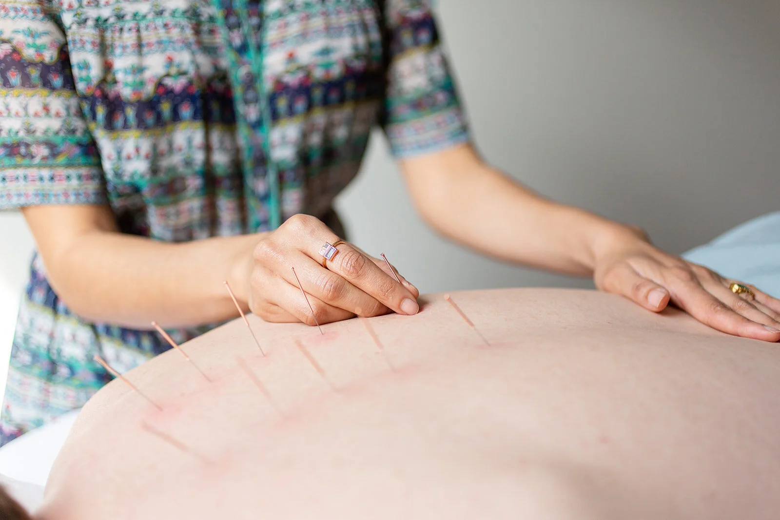 Acupuncture and Herbal Medicine Services — Little Dragon Wellness DC