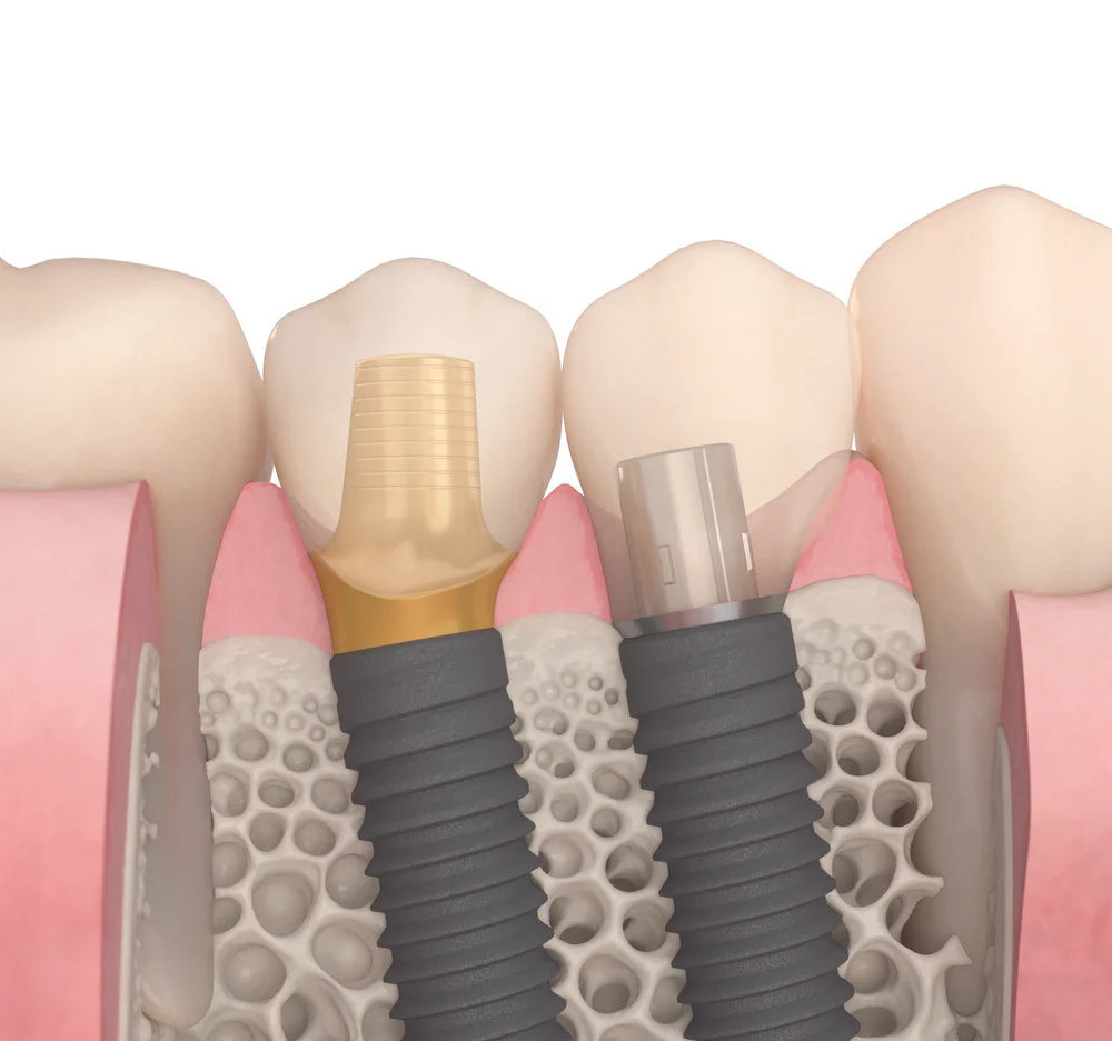 Omnitek Dental Ceramics, Inc.Omnitek Dental Ceramics