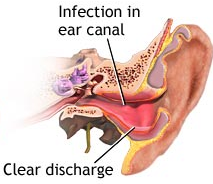 otitis externa.png