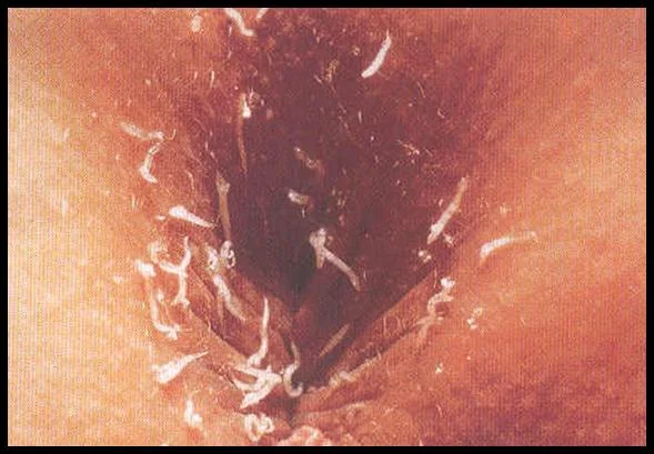 pinworm.jpg