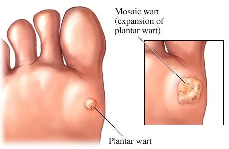plantar-wart1.jpg