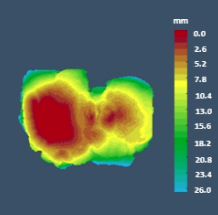  Joint space color map distribution.&nbsp;Red regions indicate narrower joint spacing.&nbsp; 