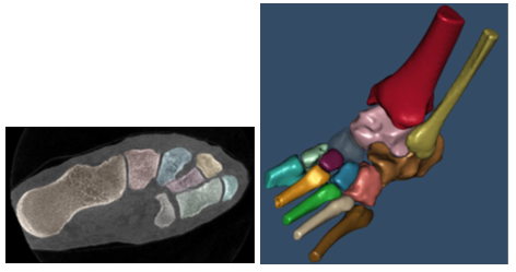  Interactive bone segmentation of the foot: labelled bone masks overlaid to the original slice and&nbsp;surface rendering of the foot.&nbsp; 