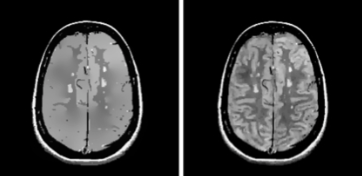   Brain&nbsp;MR&nbsp;with multiple sclerosis lesions after 500 iteration of a  nisotropic diffusion(left), and stabilized diffusion via s-scale (right).&nbsp;  