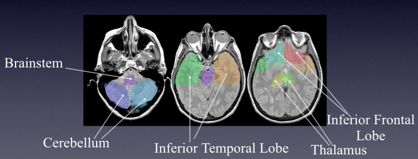  Automated labeling of deep brain regions using atla-based deformable registration 