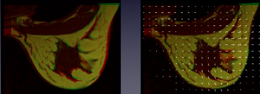  Free-form B-spline&nbsp;deformable registration for breast imaging evaluation 