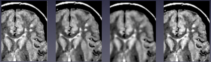  Original PD brain MR image of a multiple sclerosis patient (left) followed by resulting images&nbsp;after applying&nbsp;ball scale, classical and&nbsp;generalized scale diffusion filtering 
