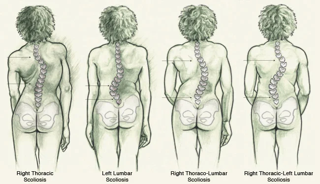 http://perfectformphysio.com.au/portfolio/scoliosis/