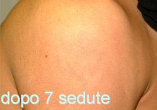 Shoulder 03 After 03.jpg