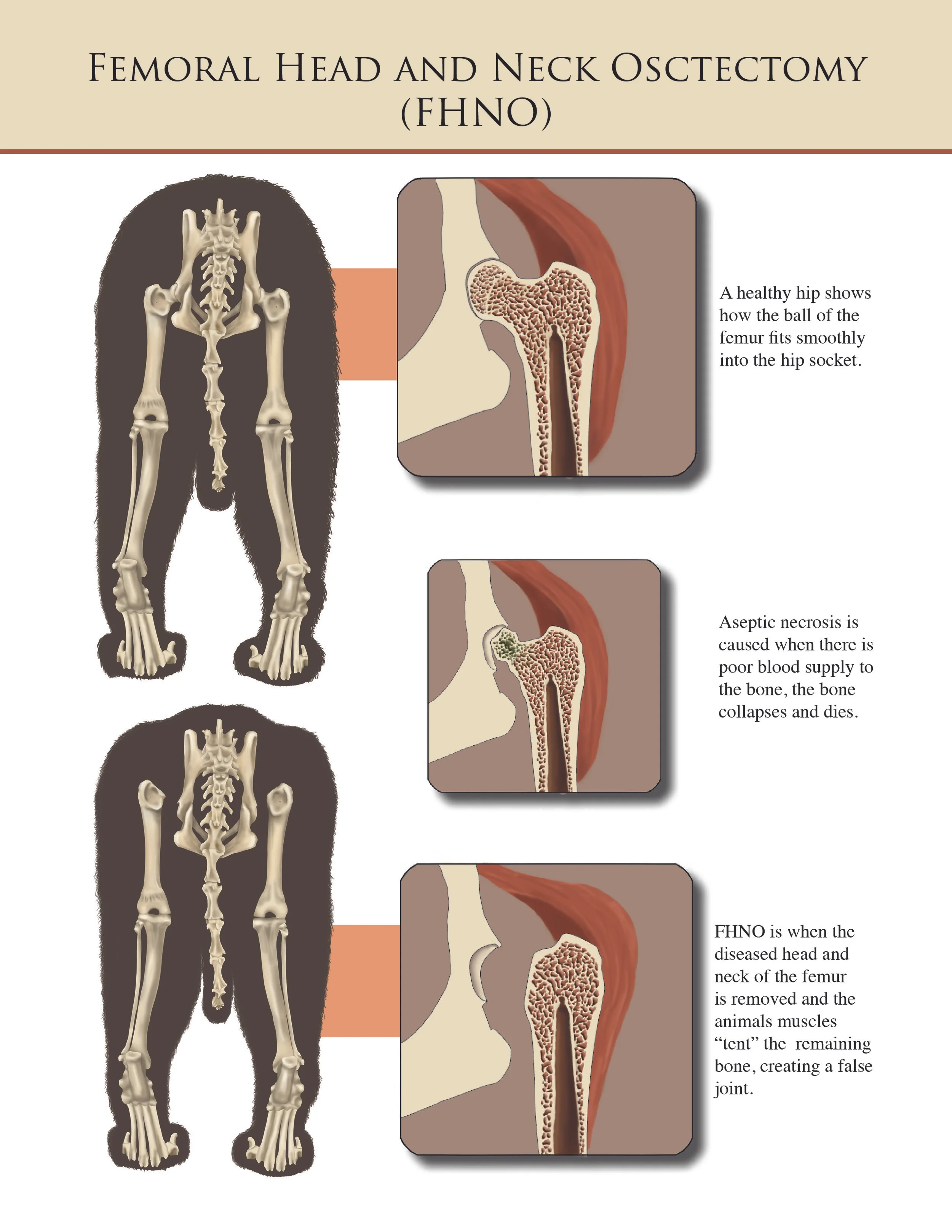 Femoral Head and Neck Osctectomy