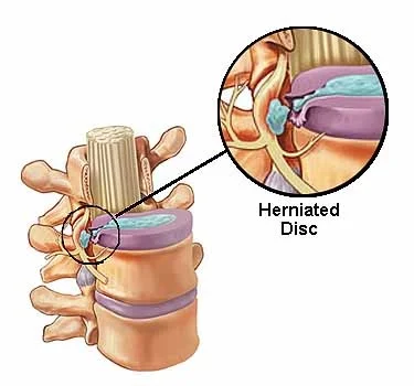 herniated disk | back pain
