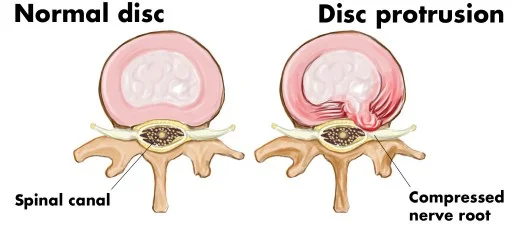 spinal canal
