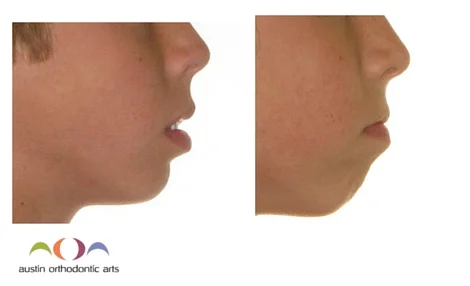 Can Braces Change Your Lips | Lipstutorial.org