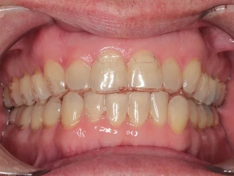 With Invisalign