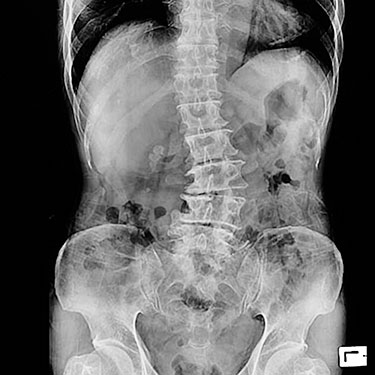 Scoliosis-x-ray DJD.jpg