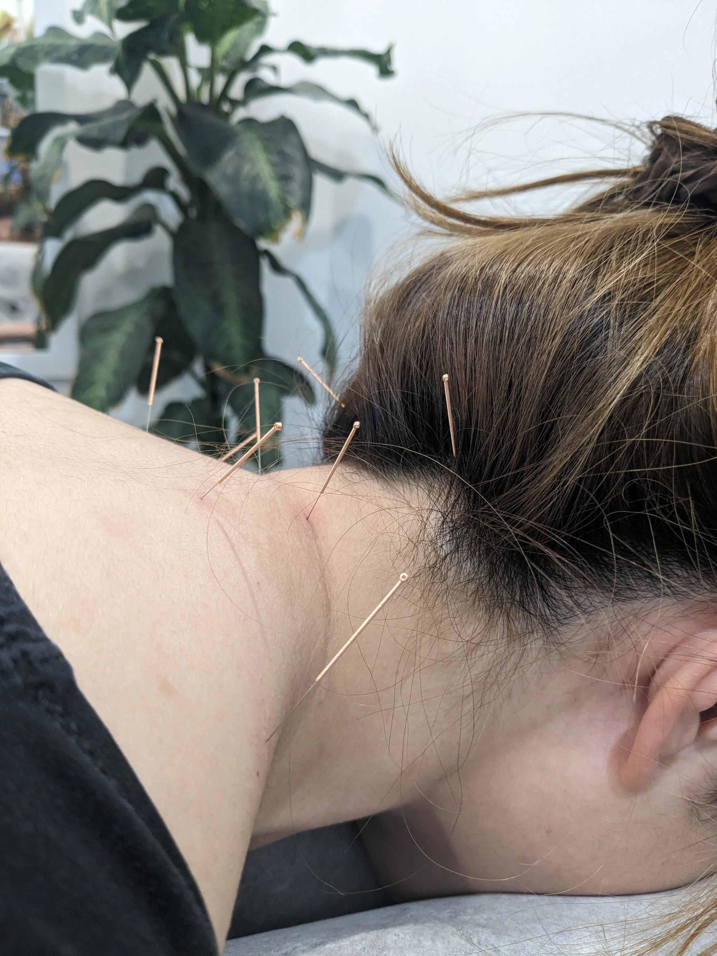 Dry needling for neck pain in Riverview, near Lane Cove and Hunters Hill