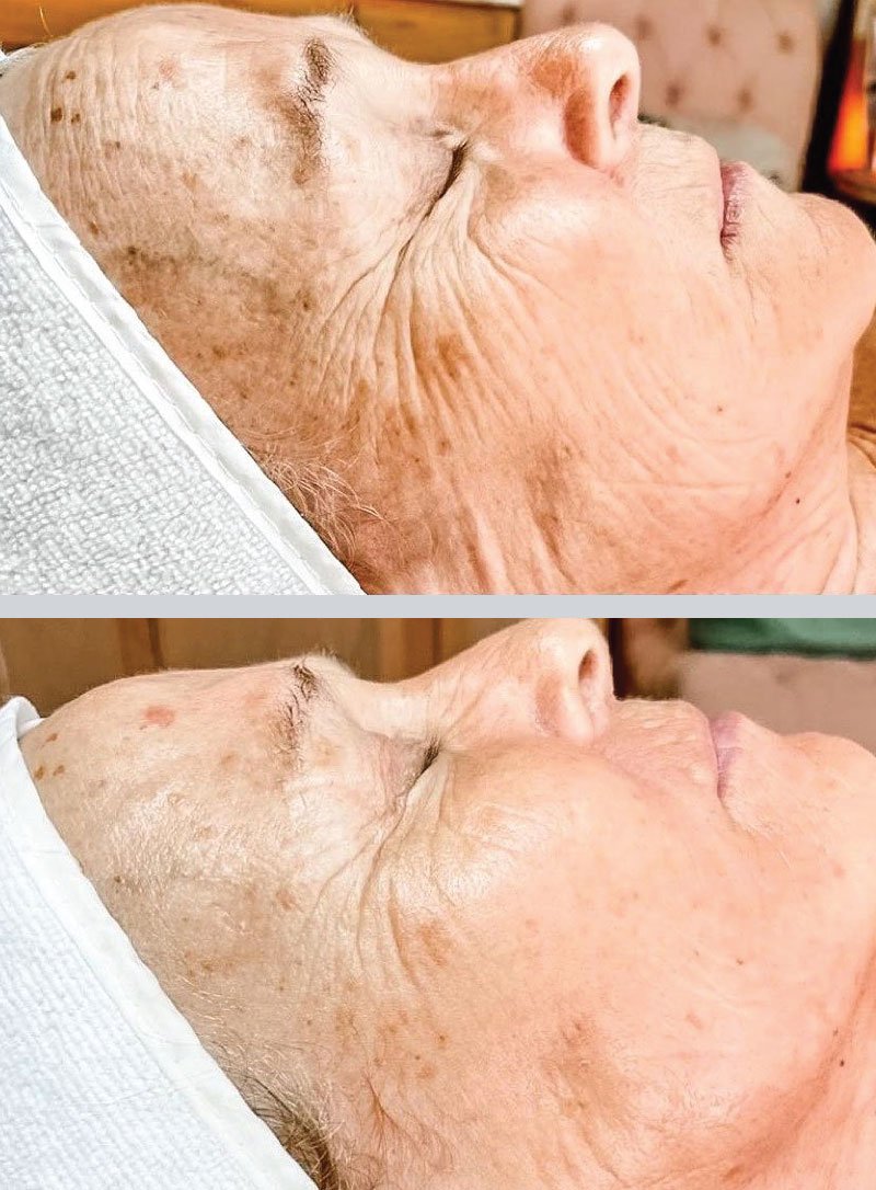 anti-wrinkles-treatment-non-invasive-machine-ontario.jpg