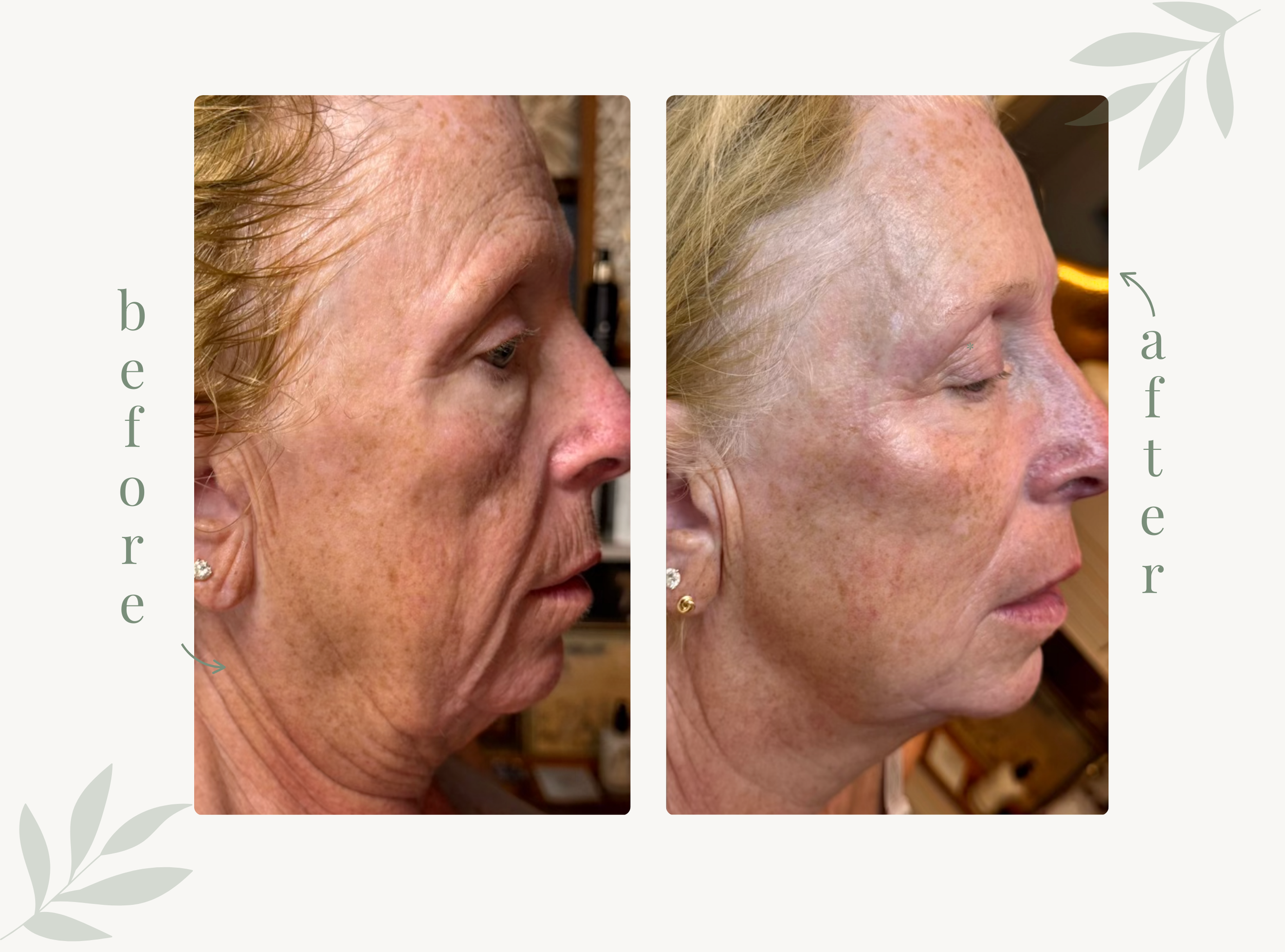 Microcurrent facial sculpting before and after at pure eco spa.