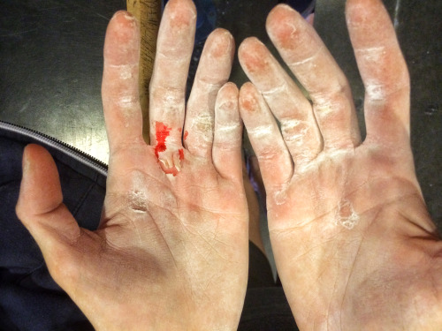 Flappers (ripping calluses) on my hands due to improper skin care after a long session training for sport climbing. Photo: Claire Bukowski