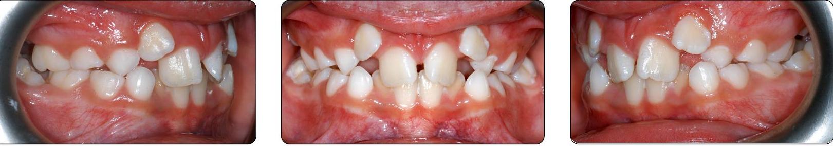 teeth before Phase I