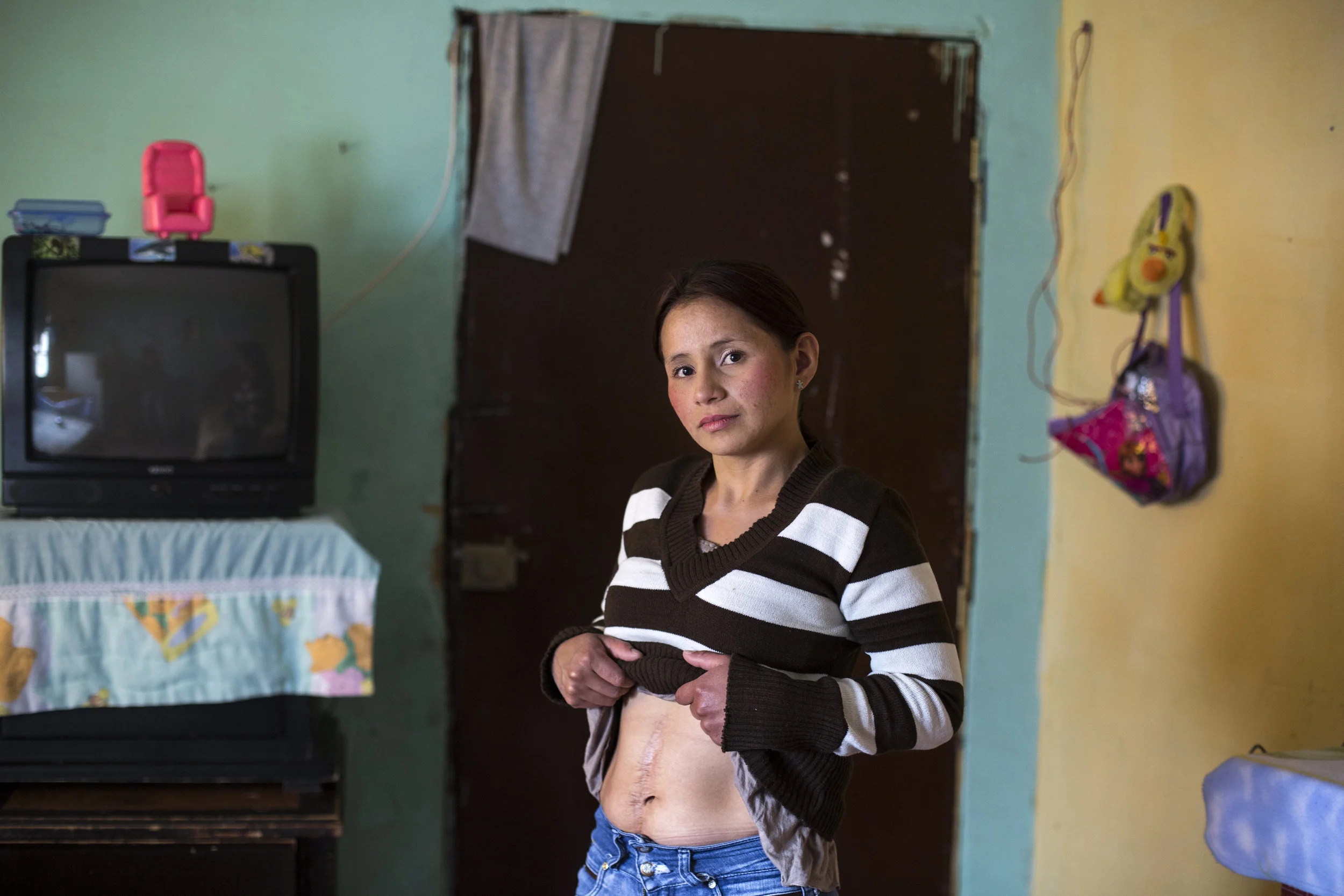 Maria Del Mar Toledo, 25, shows her scar from being shot while fighting for the FARC while in the one-bedroom apartment in Bogotá, Colombia on September 21, 2016. Toledo was 11 when she joined the FARC and demobilized after being shot at 17. She wishes the Colombian Peace Deal would include people like her. Toledo lives in Ciudad Bolivar, one of the most dangerous areas of Colombia's capital city of Bogotá. 