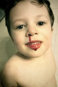 Understanding nosebleeds