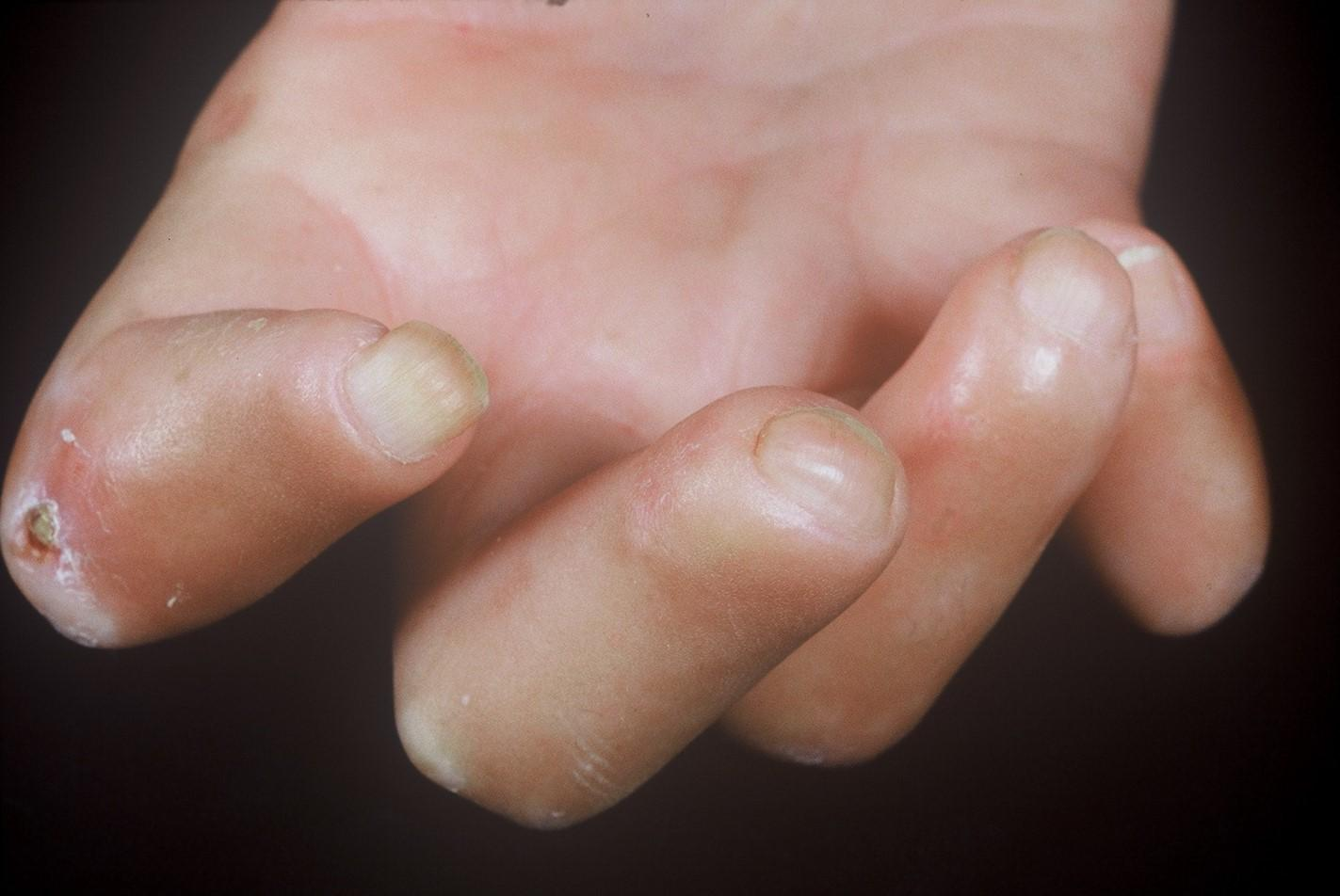Close-up photograph of hands illustrating sclerodactyly, showing tight, shiny skin, reduced finger movement, and slight bending at the joints.