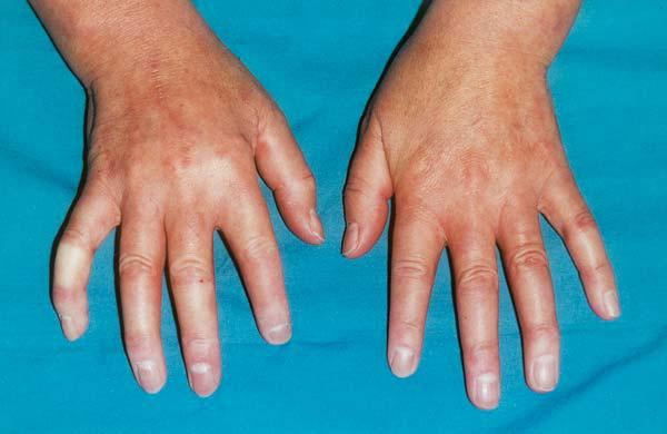 Close-up view of hands showing puffy, swollen fingers with tight, shiny skin and pale fingertips associated with sclerodactyly.