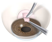 In trabeculectomy, a flap is first created in the sclera (the white part of the eye). Then a small opening is made into the eye to release fluid from the eye.