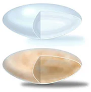 The top lens is clear. The bottom lens shows clouding by cataract.