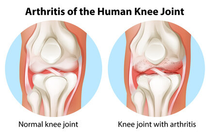 arthritis of the knee.jpg