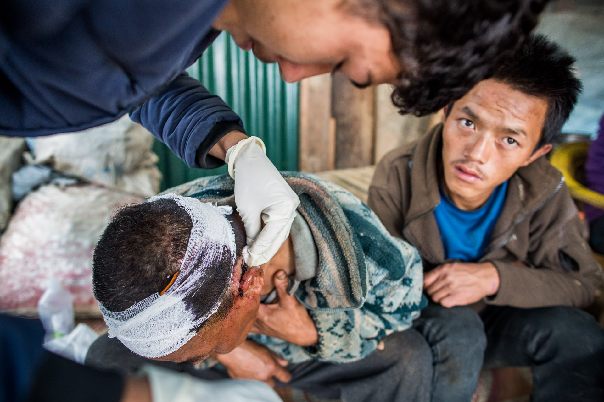 Setious head wound treated by the healthpost worker. 