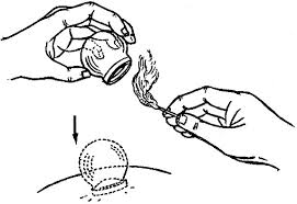 Cupping is a technique that has been used in many cultures to move blood and massage tissue.