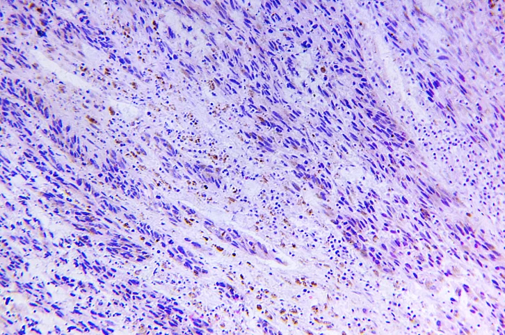 Melanoma, The most serious Form of Skin Cancer (THINKSTOCK)
