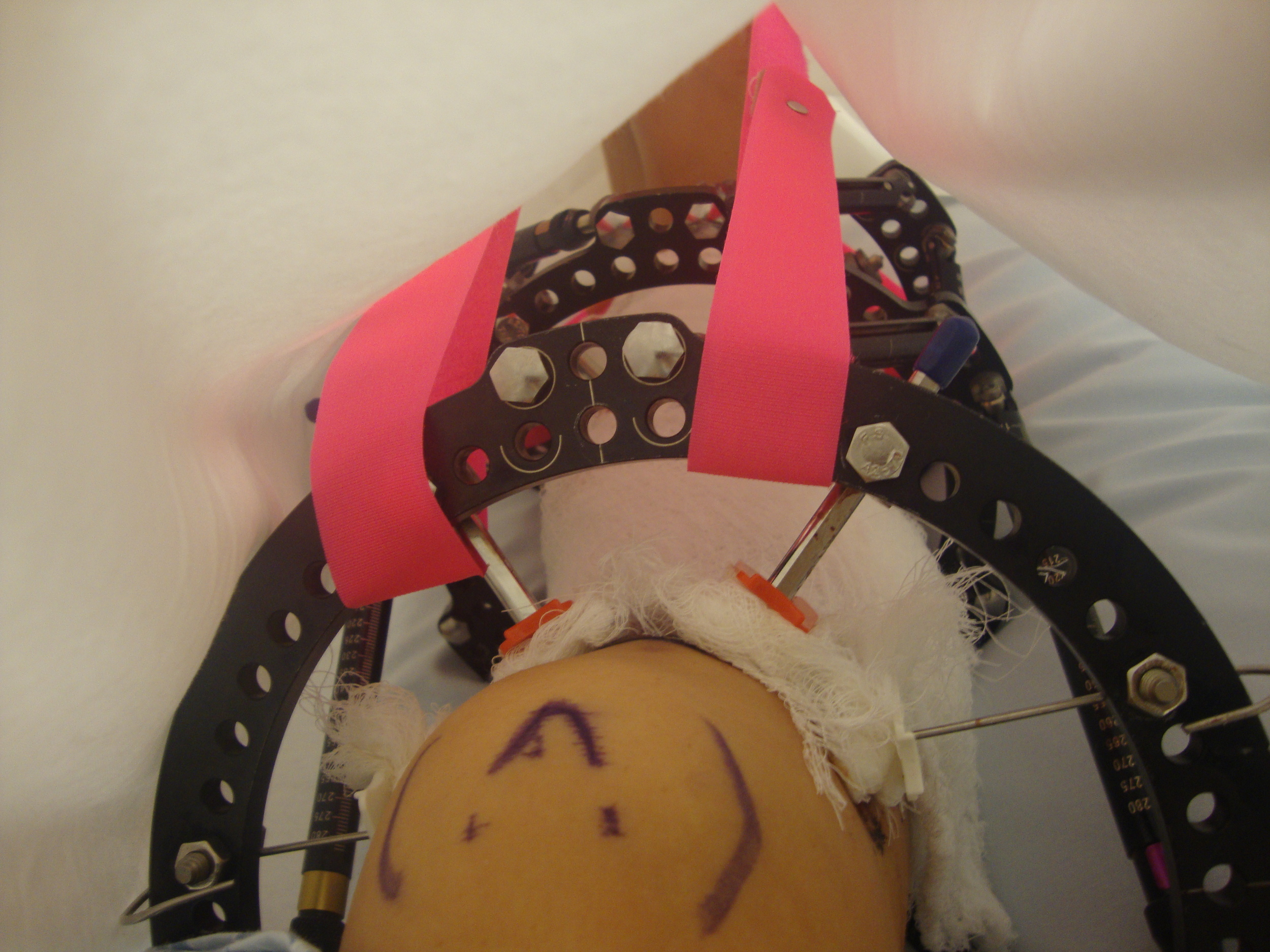 Charlotte's leg directly after surgery