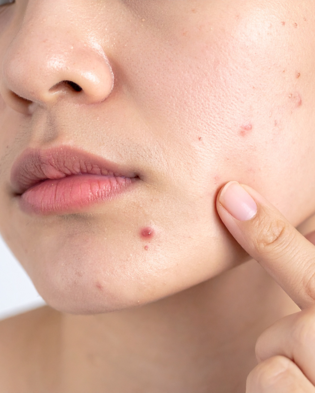 Why Harsh Acne Products Can Make Breakouts Worse