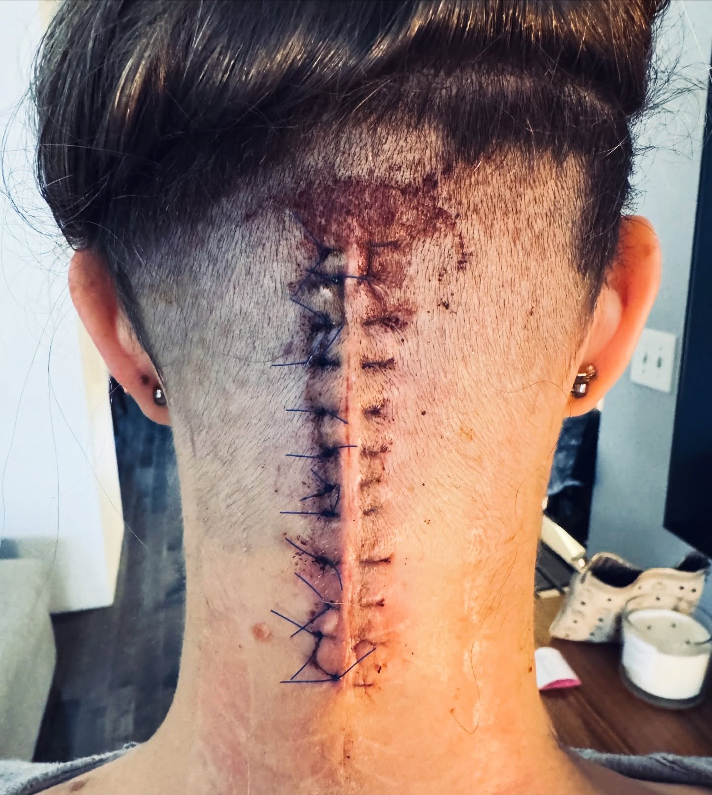 Last NYE this incision ripped through my skull and neck for the second time&mdash;removing the hunk of hardware from my occipitocervical fusion, and the surrounding sensory nerves. One week later, before the sutures were even taken out, my surgeon in
