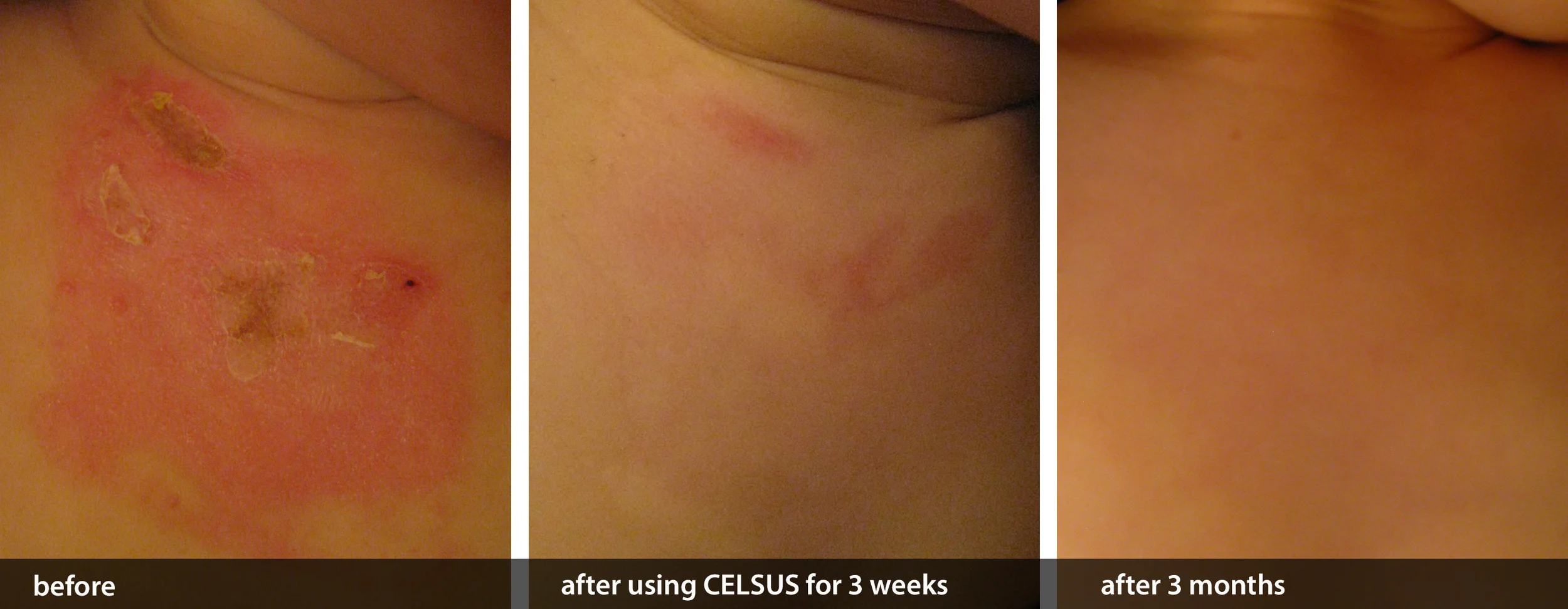 Remarkable Burn Scar Treatment Results